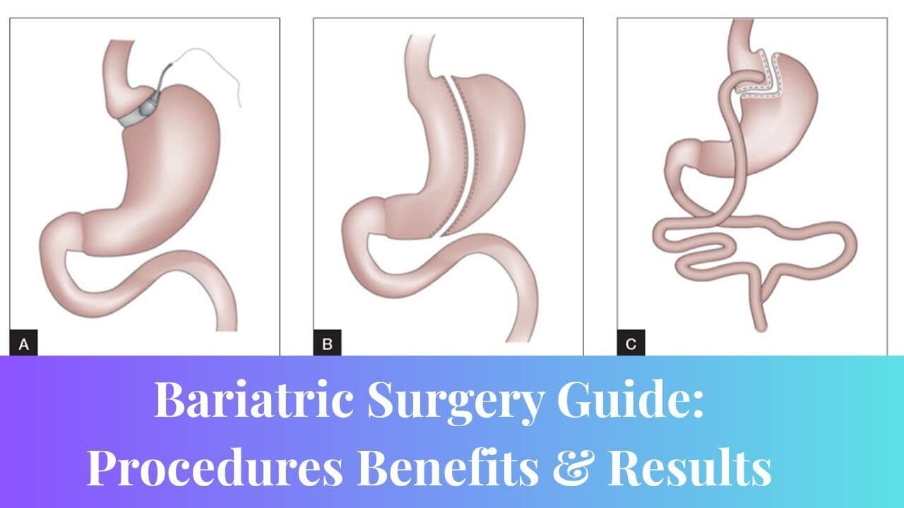 Bariatric Surgery Guide: Procedures Benefits & Results